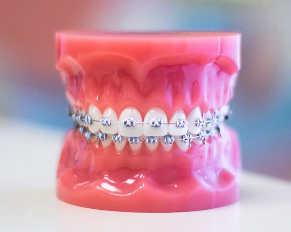 metal braces on plastic typodont